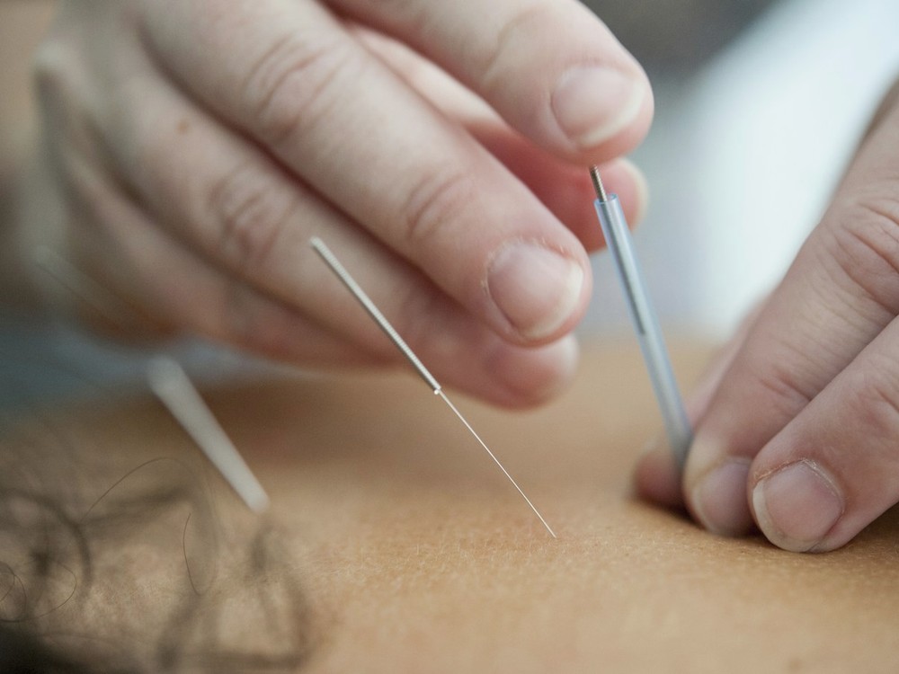 Acupuncture therapy treatment session in calm clinic